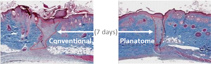 Planatome clinical